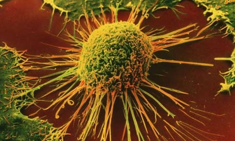 imagine cu celula canceroasa